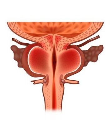 a prosztata hipotermia gyulladása az urethritis és a prosztatitis oka